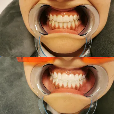 White and Beauty wybielanie zębów Leszno